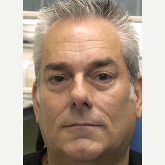 52 Year old Male treated with Botox and Restylane before 3685104