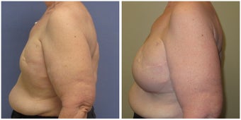Breast Revision of Breast Reconstruction after 1302578