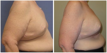 Breast Revision of Breast Reconstruction 1302578