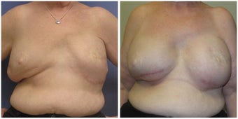 Breast Revision of Breast Reconstruction before 1302578