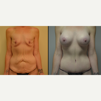 35-44 year old woman treated with Mommy Makeover before 3837003