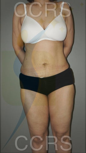 VASER lipo with mini TT - 45 yrs. old female after 636187