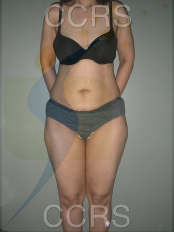 VASER lipo with mini TT - 45 yrs. old female before 636187