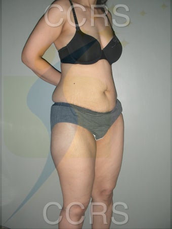 VASER lipo with mini TT - 45 yrs. old female 636187