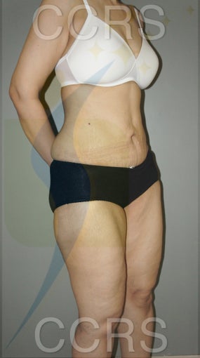 VASER lipo with mini TT - 45 yrs. old female 636187