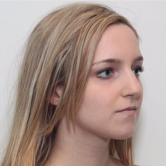 25-34 year old woman treated with Rhinoplasty before 3224680