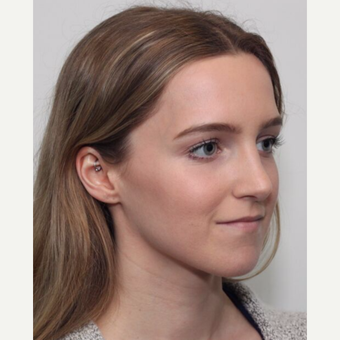 25-34 year old woman treated with Rhinoplasty after 3224680