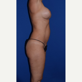 35-44 year old treated with Mommy Makeover Breast Augmentation and Liposuction of Abdomen & Thighs after 3105081