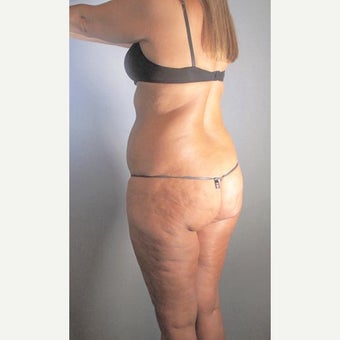 45-54 year old woman treated with Brazilian Butt Lift before 2661624