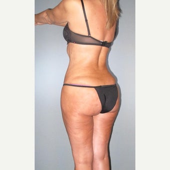 45-54 year old woman treated with Brazilian Butt Lift after 2661624