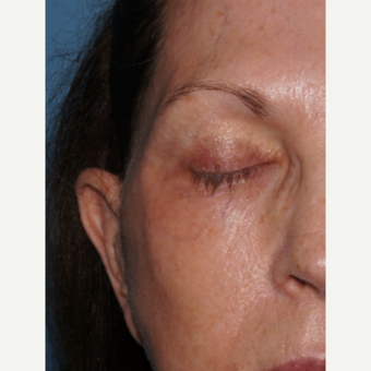 65-74 year old woman treated with ExcelV to remove dark veins around eyes after 3482420