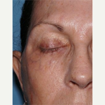 65-74 year old woman treated with ExcelV to remove dark veins around eyes before 3482420