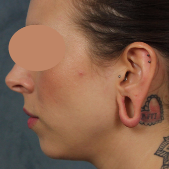 Gauge earlobe repair for extreme size gauges with earlobe lift and reconstruction before 3623480