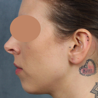 Gauge earlobe repair for extreme size gauges with earlobe lift and reconstruction after 3623480