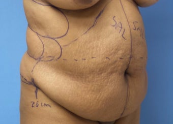 35-44 year old woman treated with Tummy Tuck before 3168295