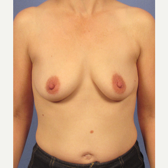 35-44 year old woman treated with Breast Implants before 3106753