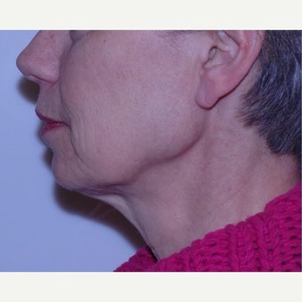 Face and neck lift with deep tissue suspension = Natural results before 2262901