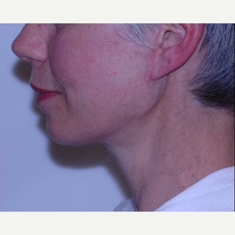 Face and neck lift with deep tissue suspension = Natural results after 2262901