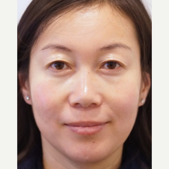 45-54 year old woman treated with Eye Bags Treatment before 3698511