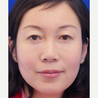 45-54 year old woman treated with Eye Bags Treatment after 3698511