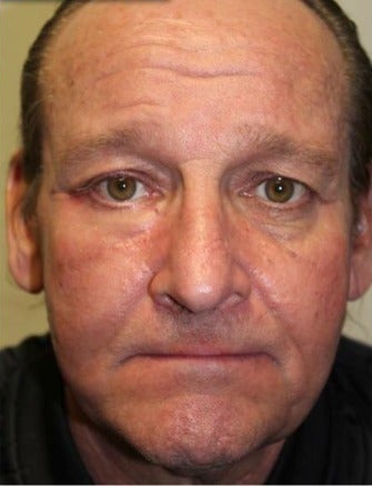 45-54 year old man treated with Eyelid Surgery after 3238873