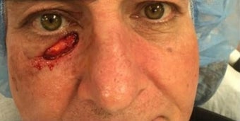 45-54 year old man treated with Eyelid Surgery before 3238873