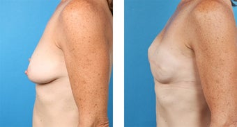 48 Year Old Woman, Cassileth One-Stage Breast Reconstruction after 1039926