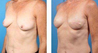 48 Year Old Woman, Cassileth One-Stage Breast Reconstruction 1039926