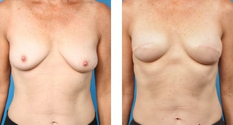 48 Year Old Woman, Cassileth One-Stage Breast Reconstruction before 1039926