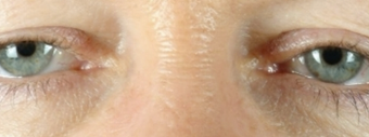Eyelid Surgery before 502774