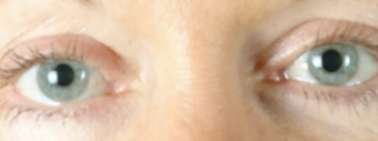 Eyelid Surgery after 502774