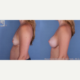 35-44 year old woman treated with Breast Augmentation after 3770094