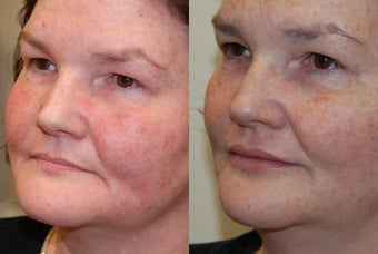 Silikon-1000 for Lip Augmentation and Marionette Grooves. before 1036189