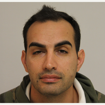 45-54 year old man treated with FUE Hair Transplant before 3616773