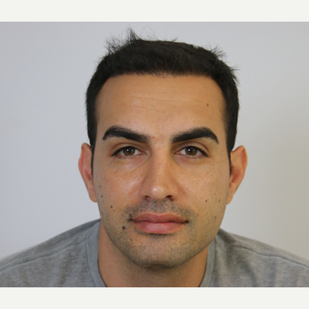 45-54 year old man treated with FUE Hair Transplant after 3616773
