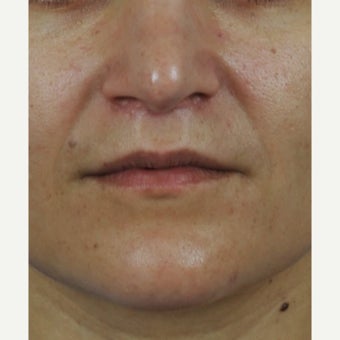 Upper lip lift after 2533453