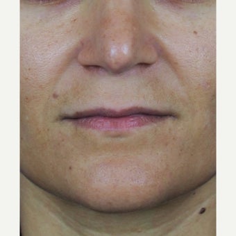 Upper lip lift before 2533453