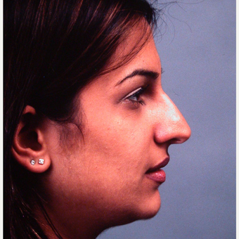 18-24 year old man treated with Rhinoplasty before 3686905