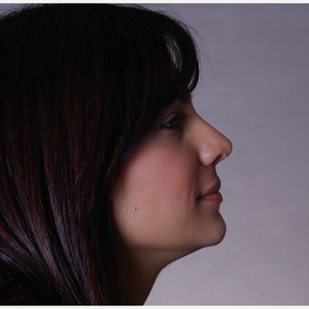 18-24 year old man treated with Rhinoplasty after 3686905