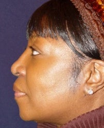 Rhinoplasty Side View after 874489
