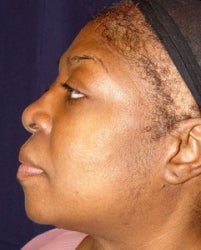 Rhinoplasty Side View before 874489