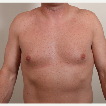 25-34 year old woman treated with Male Breast Reduction before 3060283