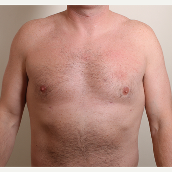 25-34 year old woman treated with Male Breast Reduction after 3060283