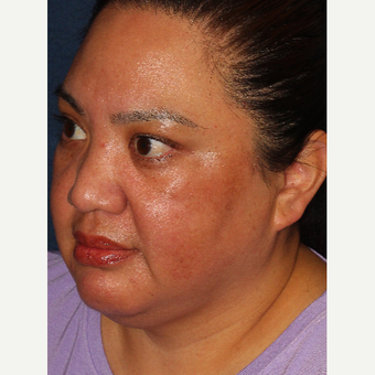 25-34 year old woman treated with Laser Treatment after 3220120