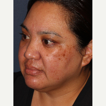 25-34 year old woman treated with Laser Treatment before 3220120