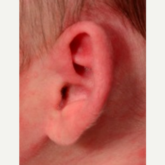 Non-surgical newborn ear correction before 3417186