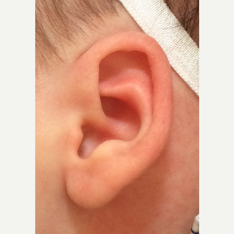 Non-surgical newborn ear correction after 3417186