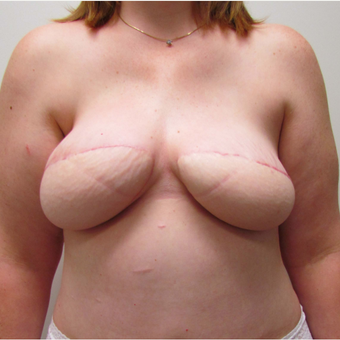 DIEP Flap Breast Reconstruction for this 39 Year Old Woman after 3305389