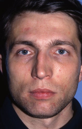 Revision Rhinoplasty before 981036