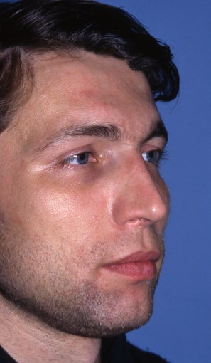 Revision Rhinoplasty 981036